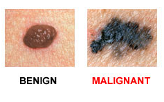 http://www.biomedia.vn/uploads/Picture/ngan-1/melanoma-2.png