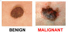 http://www.biomedia.vn/uploads/Picture/ngan-1/melanoma-3.png