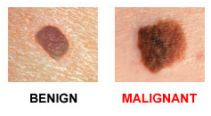 http://www.biomedia.vn/uploads/Picture/ngan-1/melanoma-4.png