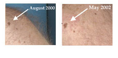 http://www.biomedia.vn/uploads/Picture/ngan-1/melanoma-5.png
