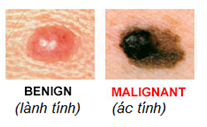 http://www.biomedia.vn/uploads/Picture/ngan-1/melanoma-1.png